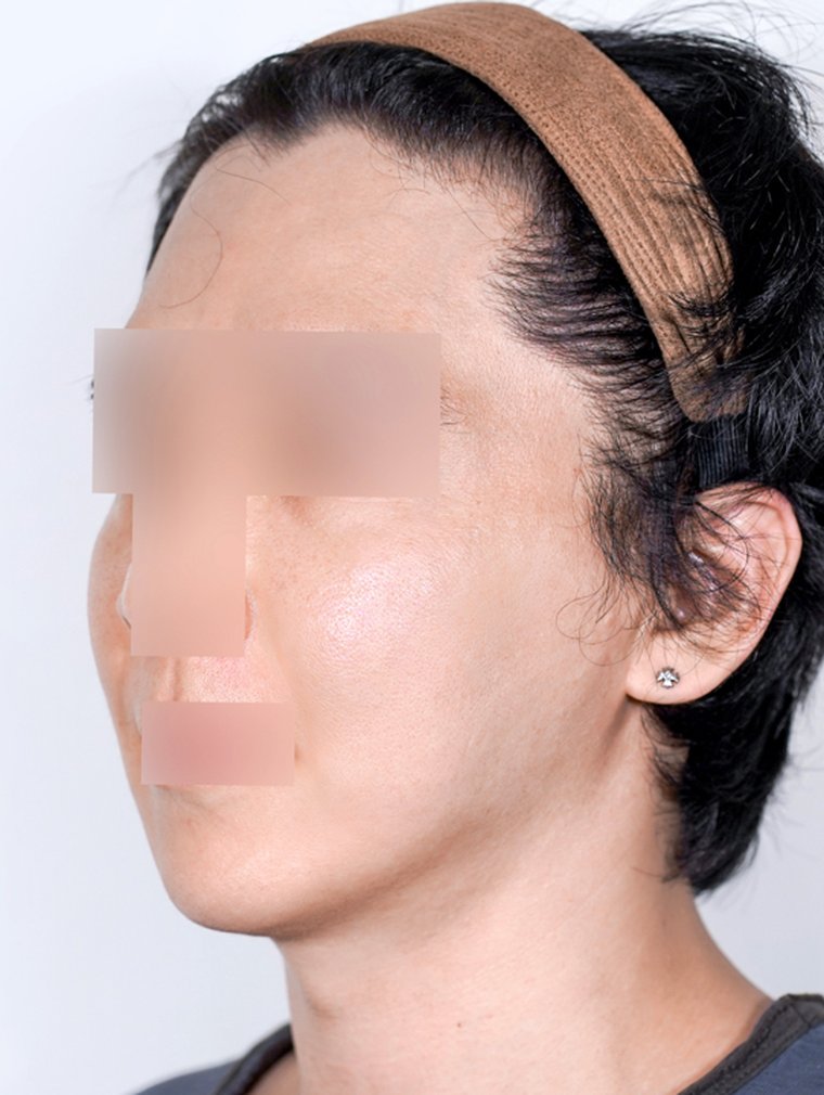 Thermage FLX after, MILI Clinic Dosan