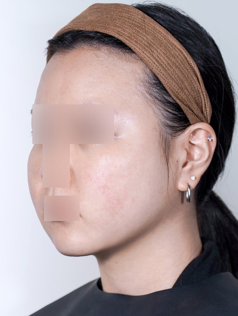 Tuneface after, MILI Clinic Dosan
