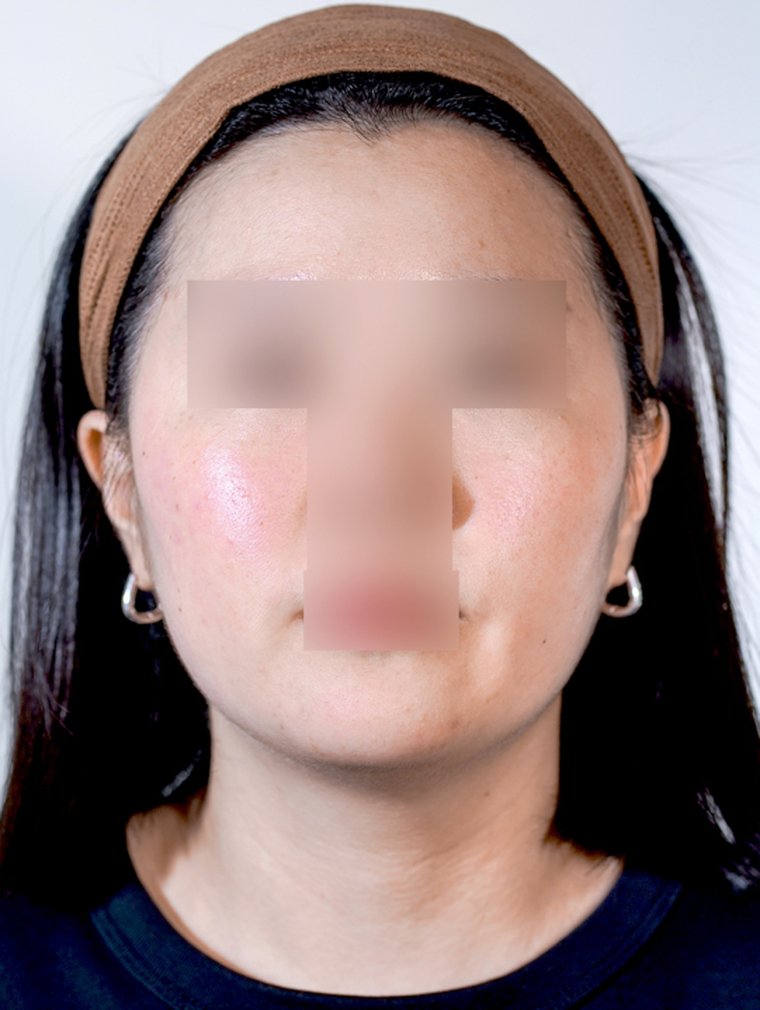 Ultherapy Prime after, MILI Clinic Dosan
